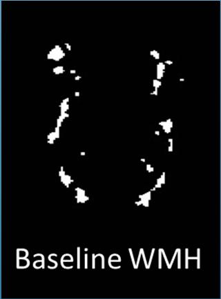 penumbra is highly correlated with longitudinal change in WMH,