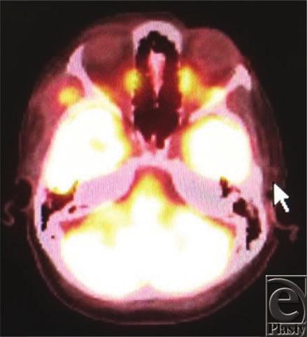APPLEBAUM ET AL 5 4 cm and was not associated with any cutaneous changes. There was no history of trauma, radiation, infection, or genetic abnormality. Figure 1. Positron emission tomography scan.