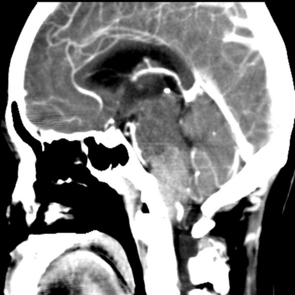 Fig. 6: sagittal 3D rebuild image indicates the location relationship between tumor and brain stem. male#67y#admitted for dizziness and unsteady gait.
