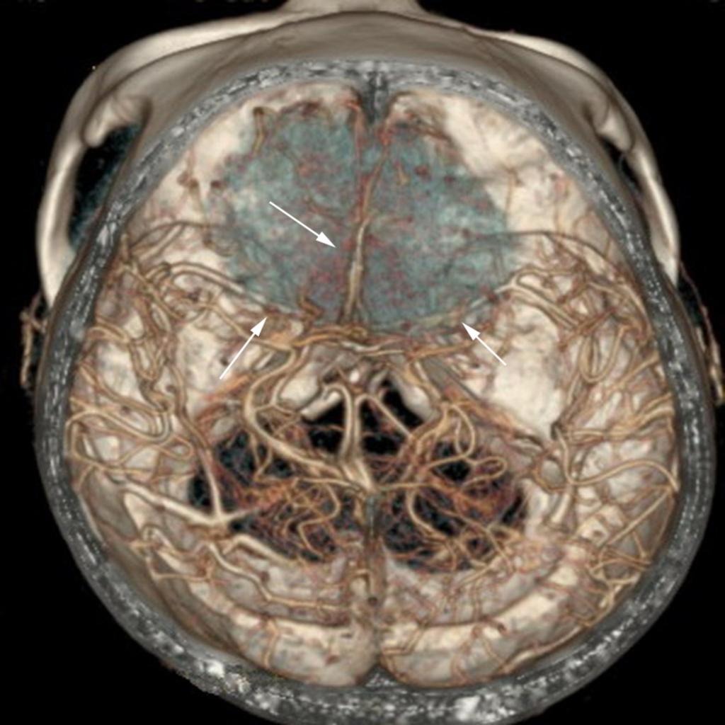 Fig. 2: horizontal 3D image indicates the location relationship among tumor, anterior and middle anterior cerebral artery.