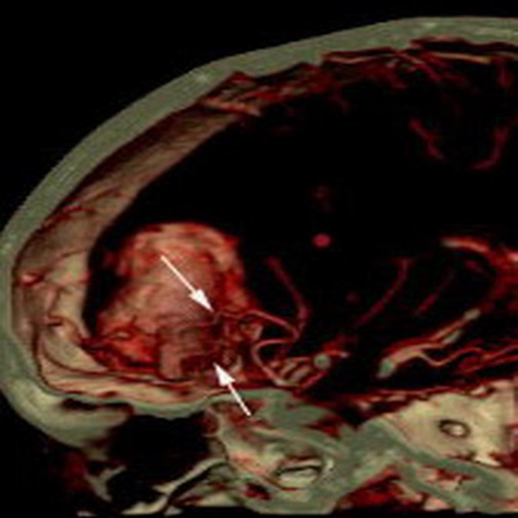 Fig. 4: indicates the characteristics of blood vessel inside tumor. male#71y.