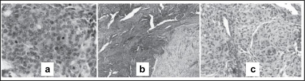 Figure : Some histologic features of different grades of meningioma: a numerous mitotic figures seen in malignant meningioma.