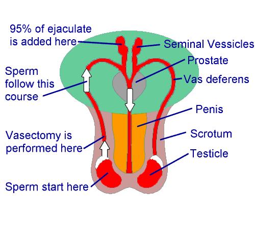 Steriliza*on: Vasectomy Vasectomy blocks sperm