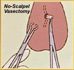 Steriliza*on: Vasectomy Vas deferens must be isolated Similar to tubal liga*on, the vas deferens can be cut