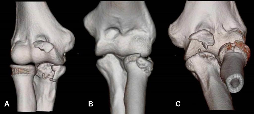 2310 Rhyou et al. Clinical Orthopaedics and Related Research 1 Fig.