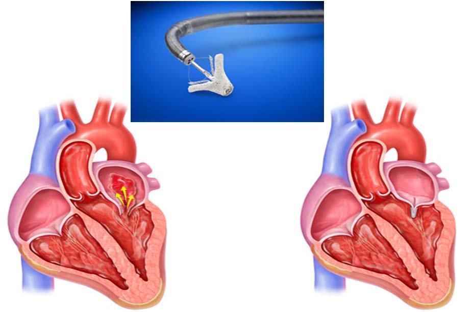 Transvascular Edge-to-Edge Mitral Valve Repair Mitral Regurgitation MitraClip Device Implanted COAPT Study Enrollment and Randomization 1576 pts with HF and MR considered for enrollment between