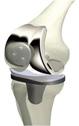 TOTAL KNEE REPLACEMENT: COMPONENTS! Femoral replaces arthritis in thigh bone!