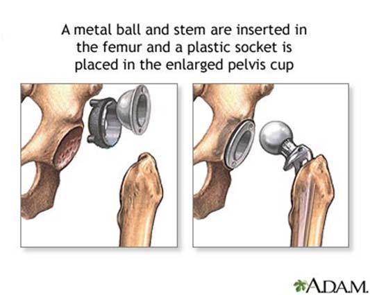 HIP REPLACEMENT SURGERY: COMPONENTS! Stem fits into the femur (thigh bone)!