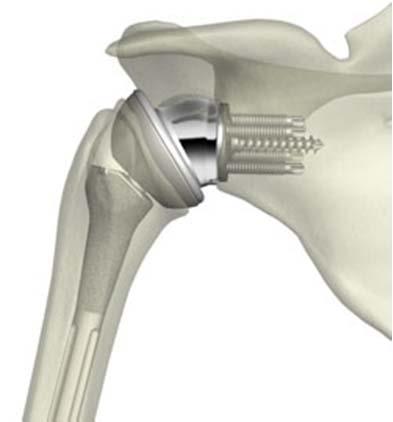 REVERSE SHOULDER REPLACEMENT: COMPONENTS! The procedure is ideal for patients with completely torn rotator cuff and effects of severe arthritis.