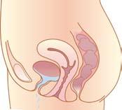 Your Body Before Incontinence Bladder MiniArc Sling System is: Safe*: Minimally Invasive Usually performed as an Outpatient Procedure in a matter of minutes Requires only one, small 1.