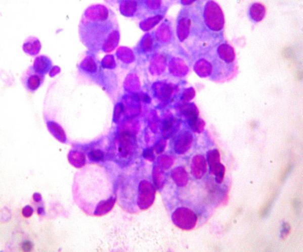 (40, Hematoxylin and Eosin) Fig.6. Photomicrograph showing signet ring cells of adenocarcinoma in Cell block.