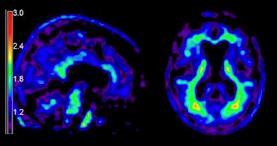 F18 Amyloid Imaging