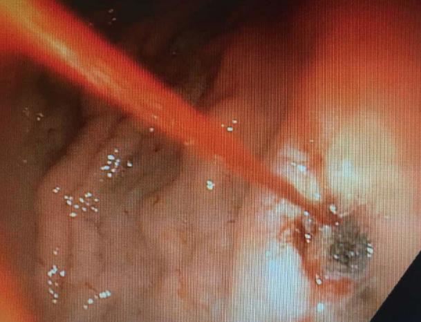 s lesion Visible