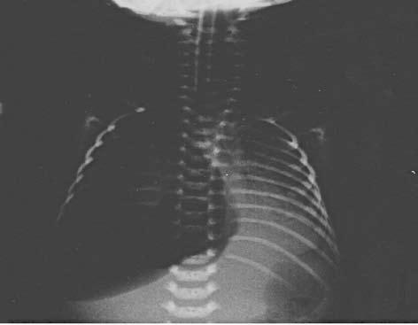 Fig. 1. Right side pneumothorax.