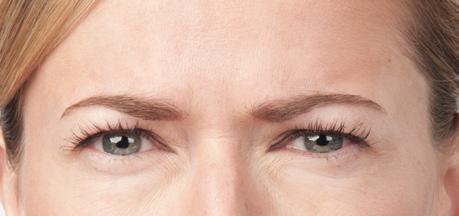 In 2 clinical studies of healthy adults, 61% and 46% had a 2-grade improvement in their forehead lines at day 30.