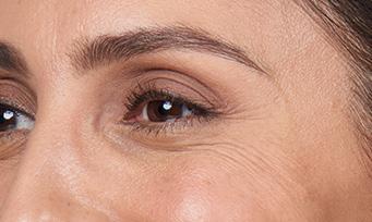 FROWN LINES For temporary improvement of moderate to severe frown lines, BOTOX Cosmetic is injected into the corrugator and procerus muscles in your brow area.