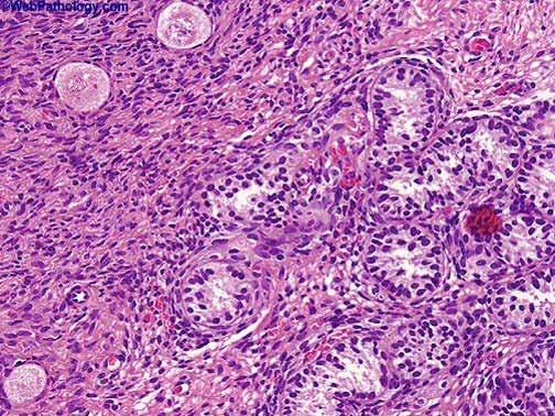 True Hermaphroditism: Both Ovarian and Testicular Cells are present in Gonadal Tissue (Ovotestis) Three ovarian follicles