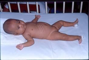 INTEGRATION OF METABOLISM PROBLEM CASE A 4-month-old baby girl was