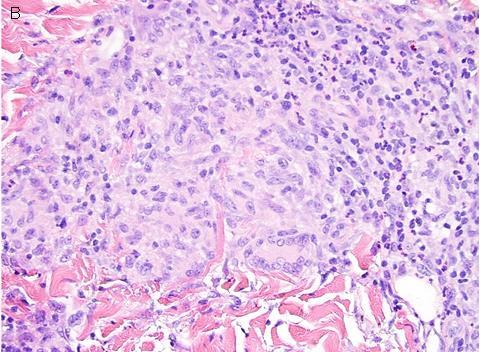 (Choice B) Metastatic cutaneous Can present as an ulceration in the genitalia Ill-defined