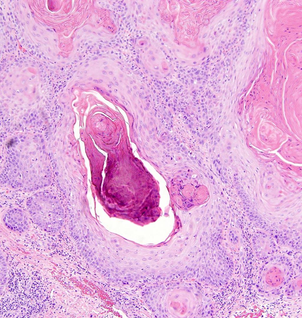 (Choice D) Squamous cell carcinoma Typically arises on the mucosal surface of the penis; presentation on the outer
