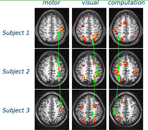 Inter-Subject Variability Human brains have similar functional structures, but there are differences in shapes and volumes (different feature spaces for different human subjects) Normalization to a