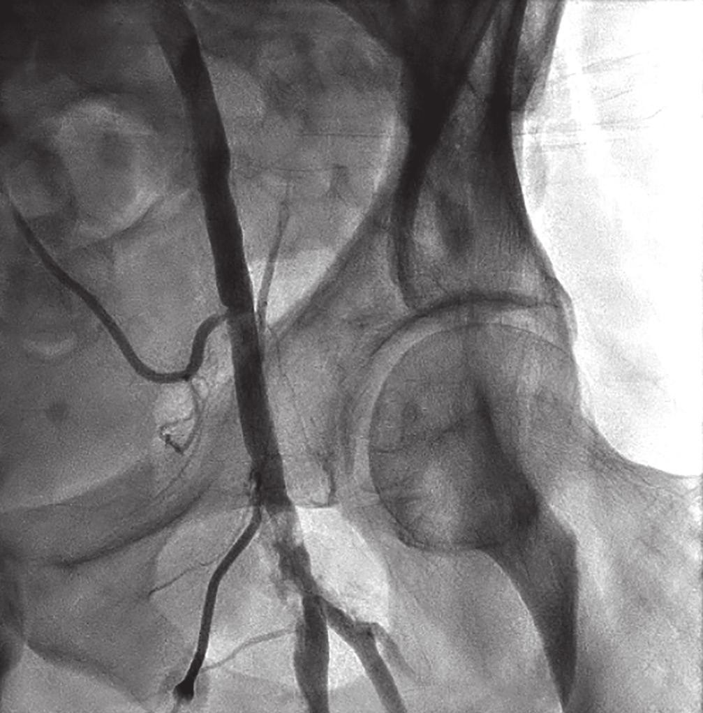 Figure 2. Left common femoral artery access site. Figure 4. Distal right SFA prior to intervention. Peripheral arterial disease affects over 200 million people worldwide.