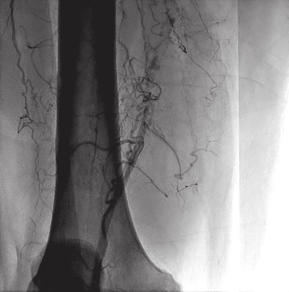 As a result, there is a greater percentage of the population presenting with Rutherford stage III claudication or greater as well as critical limb ischemia (CLI).