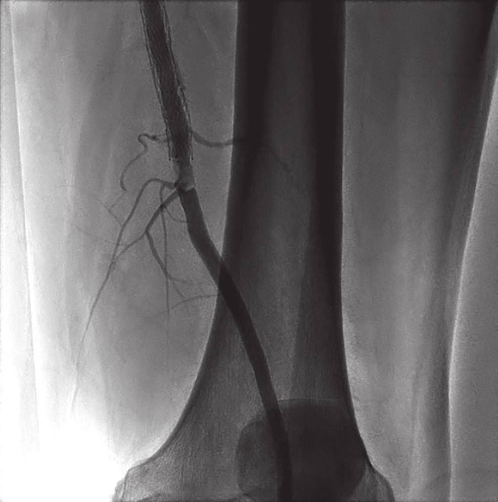 1 Quality of life measures for these patients are comparable to those of patients with terminal cancer. Figure 3. Severe distal left SFA stenosis at adductor canal.