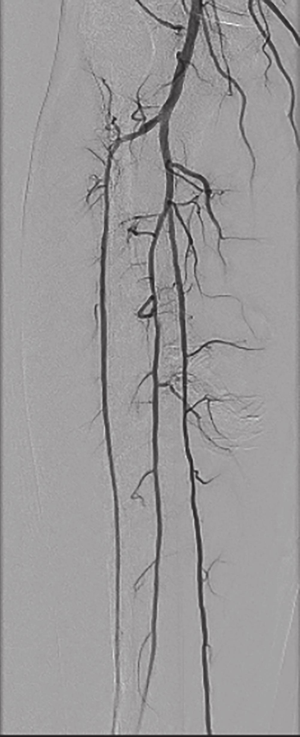 flow to acquire vascular imaging. The major advantage of this procedure is that no gadolinium is used for acquisition of angiographic imaging.