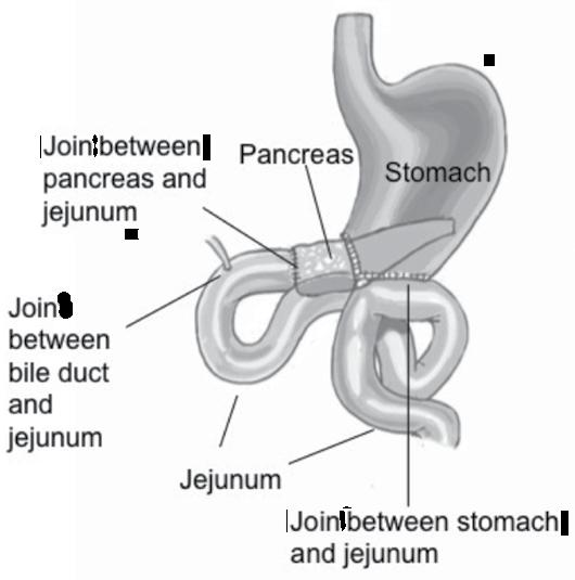 Types of operations The operation to remove the head of the pancreas is called pancreaticoduodenectomy.