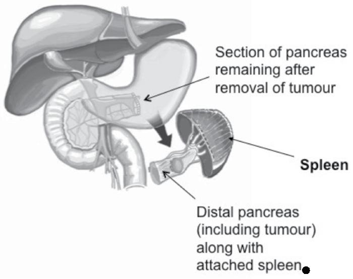 Distal pancreatectomy If the problem is in the tail of the pancreas, your surgeon will recommend an operation called distal pancreatectomy (removal of the tail of the pancreas).