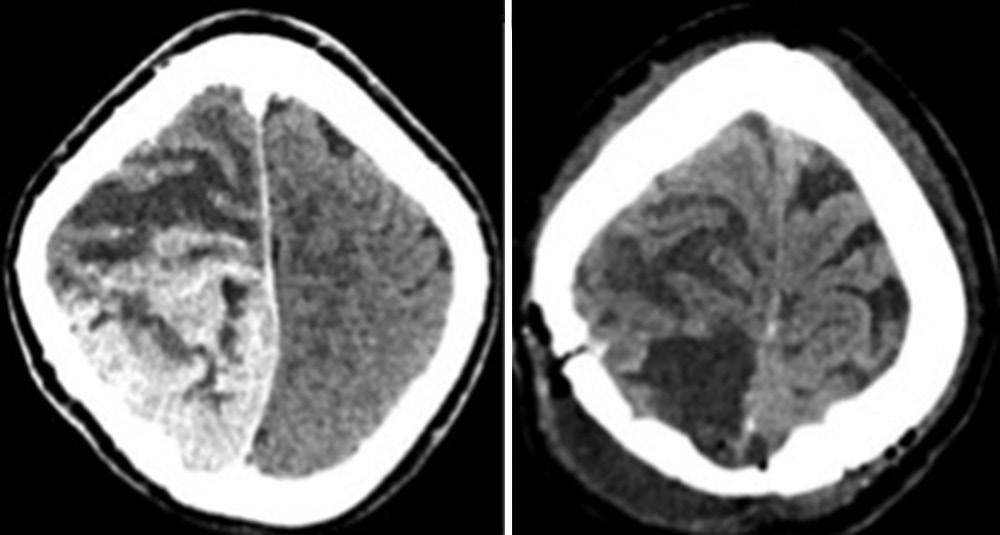 Figure 3: CT rin. () Preopertive contrst CT rin showing heterogeneously enhncing prsgittl lesion.