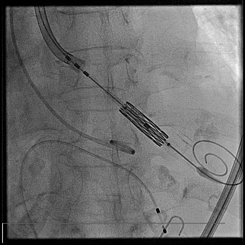 Pt. example Little calcification, severe AR significant aortic aneurysm > 6cm STS
