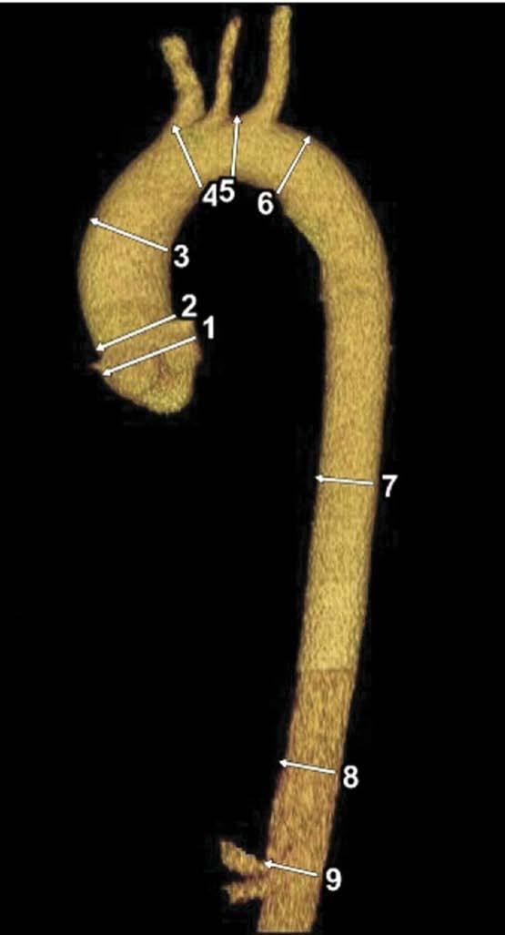 Normal anatomy of the thoracoabdominal aorta with standard anatomic landmarks for reporting aortic diameter as illustrated on a volume-rendered CT image of the thoracic