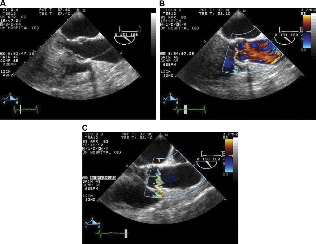Artifact mimicking dissection American College of Cardiology Foundation, et al.