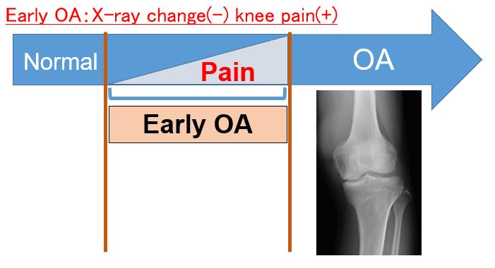 There is an increasing awareness on the importance in identifying early phases of the degenerative processes in knee osteoarthritis (OA).