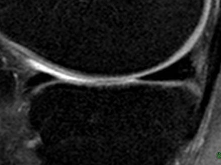 Method <Region of Interest> -mid-sagittal one slicemedial/lateral femoral condyle (MFC/LFC)