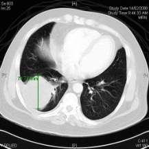 man Lung cancer