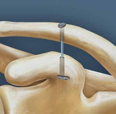 Arthroscopic Stabilization of Acute Acromioclavicular Joint Dislocation