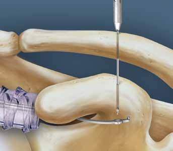 1 2 Insert the AC TightRope Constant Guide. Position the drill stop tip under the base of the coracoid as close to the scapula as possible.