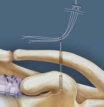 Check the position of the pin in relation to the coracoid and if incorrect, redrill the guide pin. Remove the Constant Guide and leave the guide pin in situ.