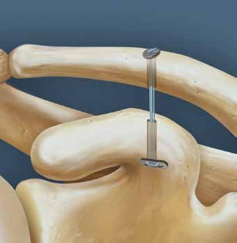 5 6 Pull the suture passing wire to retrieve the two white traction sutures out of the anterior/inferior cannula.
