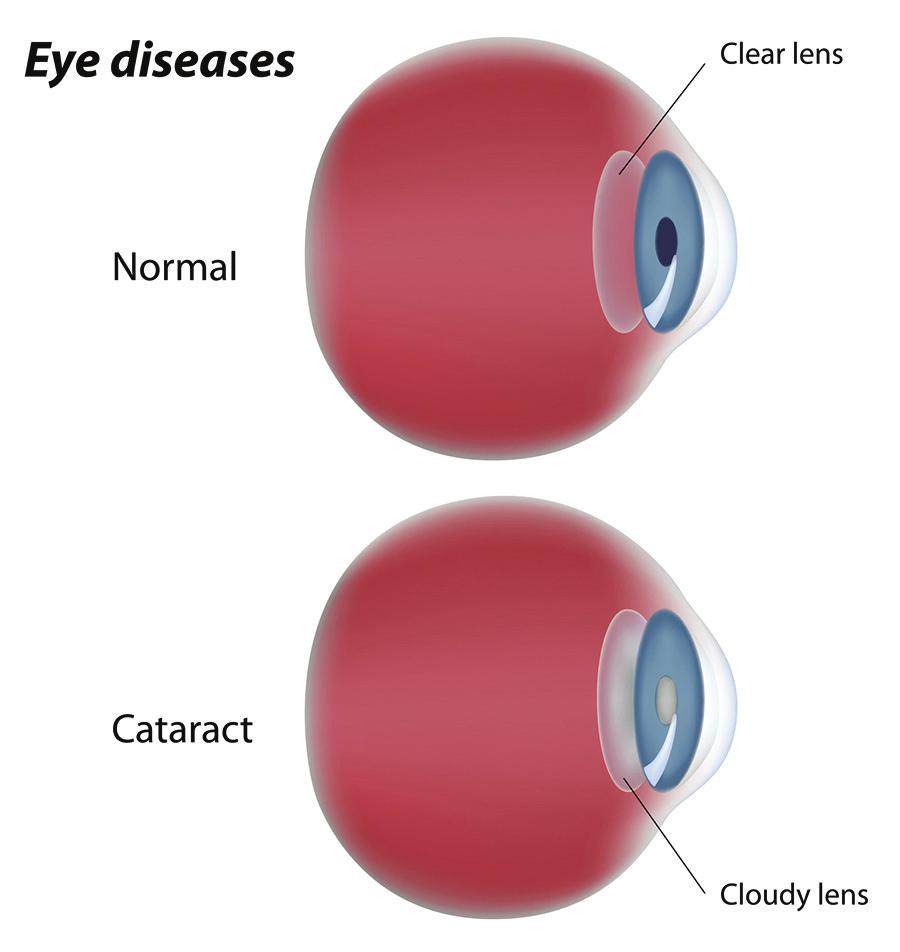 2 Introduction With advancing age, the human crystalline lens becomes progressively opacified due to a deterioration in the lens metabolism and nutrition.