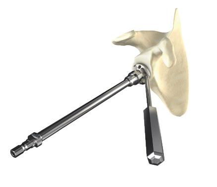 (Figure 21) Figure 20 According to surgeon preference, exposure and surgical approach, one of the two handles is selected and assembled to the Ø6 mm drill guide.