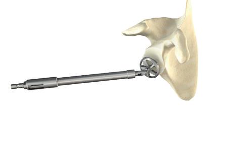 Glenoid Reaming To obtain good bone seating and secure fixation of the glenoid baseplate it is important to flatten the glenoid surface.
