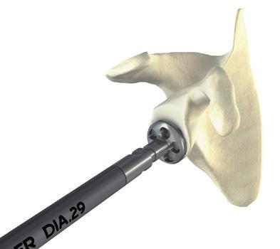 Glenoid Reaming To obtain good seating and secure fixation of the glenoid baseplate, it is important to create a flat glenoid surface using the cannulated circular reamer of the same diameter of the
