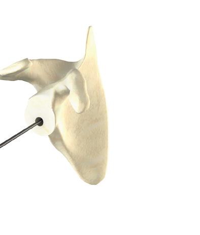 (Figure 34a) Figure 34a It is recommended to start the reamer before contacting the glenoid surface and ream until the glenoid surface is flat.