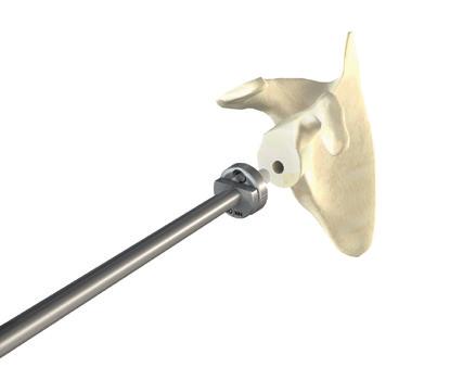 Positioning of the Glenoid Baseplate The glenoid baseplate is attached to the baseplate impactor through its central hole using a screw in the impactor central shaft.