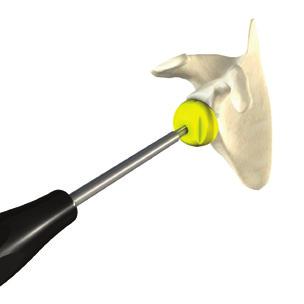 Centered glenoid sphere (standard) Figure 52 +2 mm lowered eccentric glenoid sphere (to reduce risk of scapular notching) 10 tilted glenoid sphere (to compensate the superior glenoid wear or create