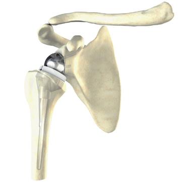 Impaction of the Humeral Insert The metaphyseal component is then thoroughly cleaned and dried.